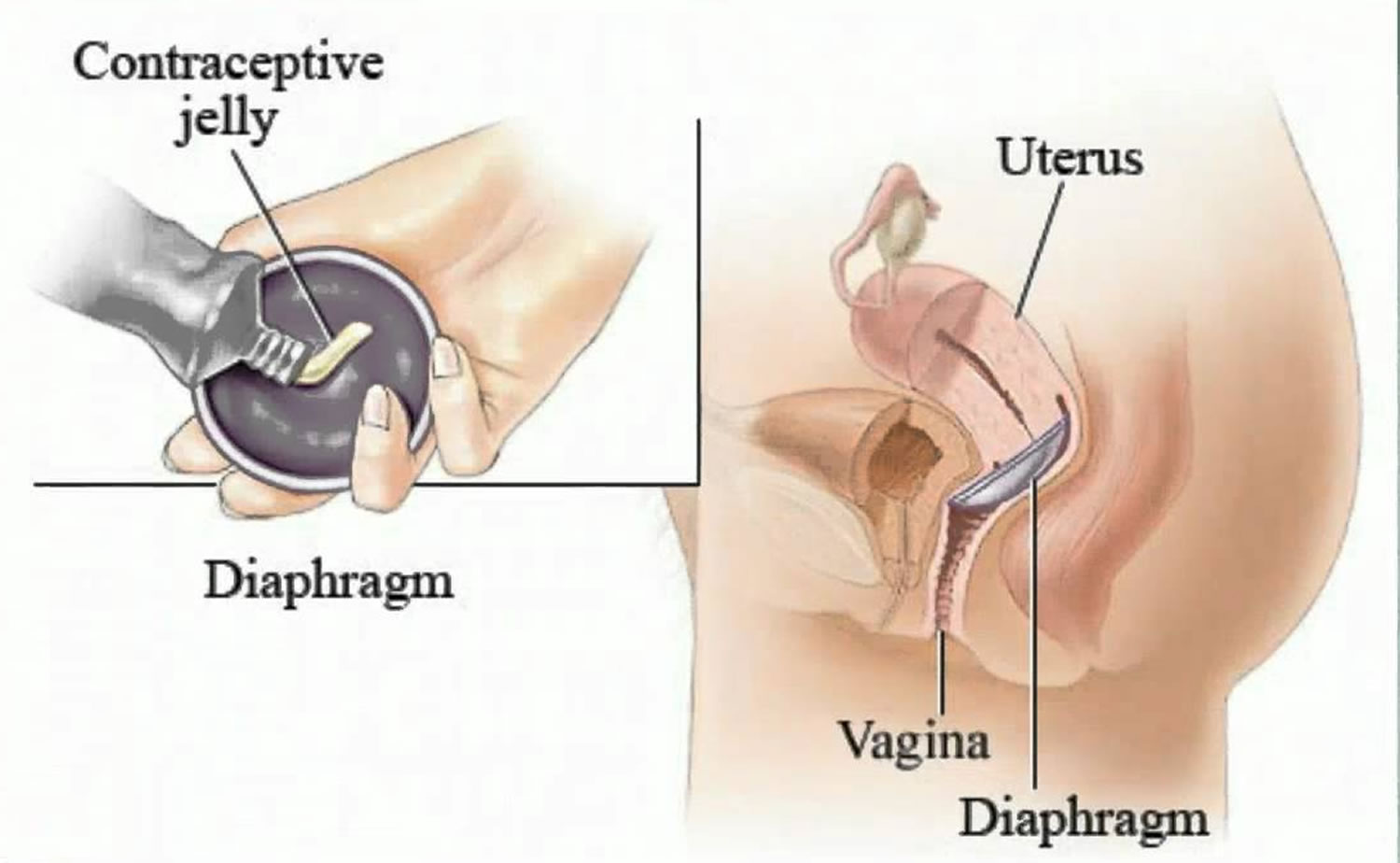 Diaphragm Pregnancy